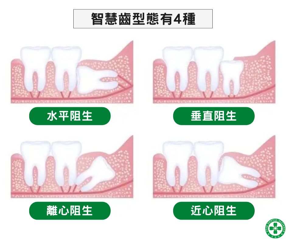 智慧齒型態有4種_Stardental