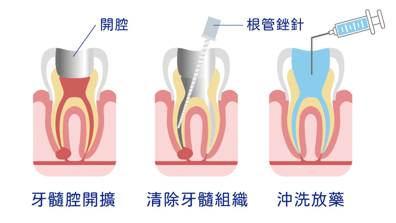 根管治療是怎麼進行的？-Stardental