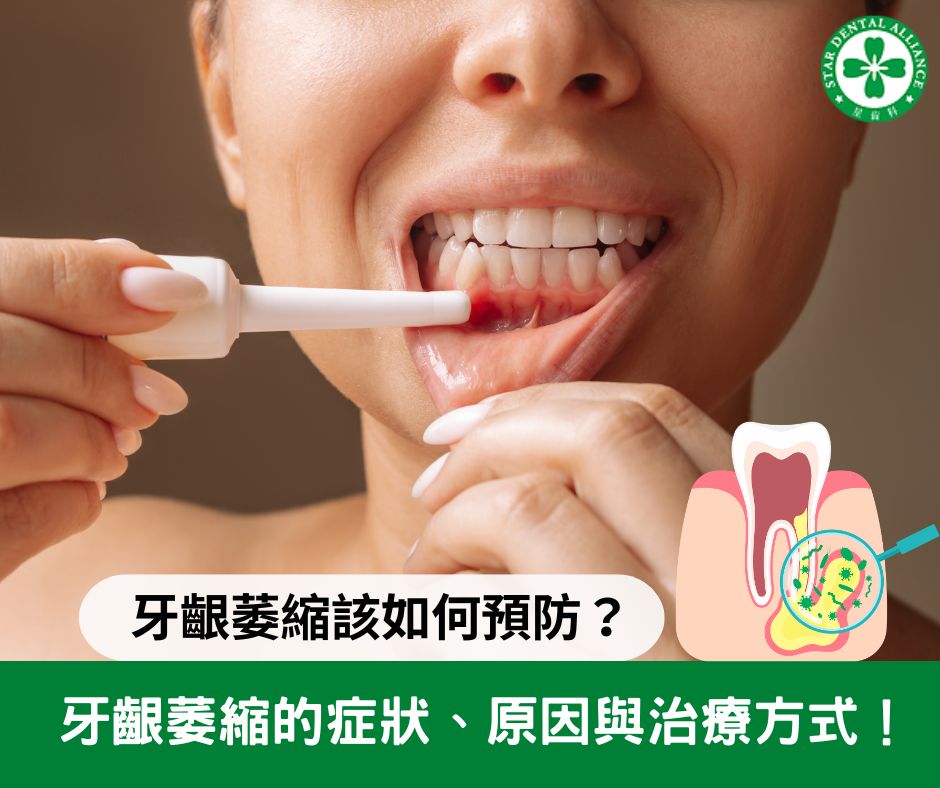 牙齦萎縮_Stardental